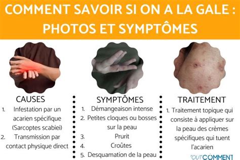 gale photos et symptômes.
